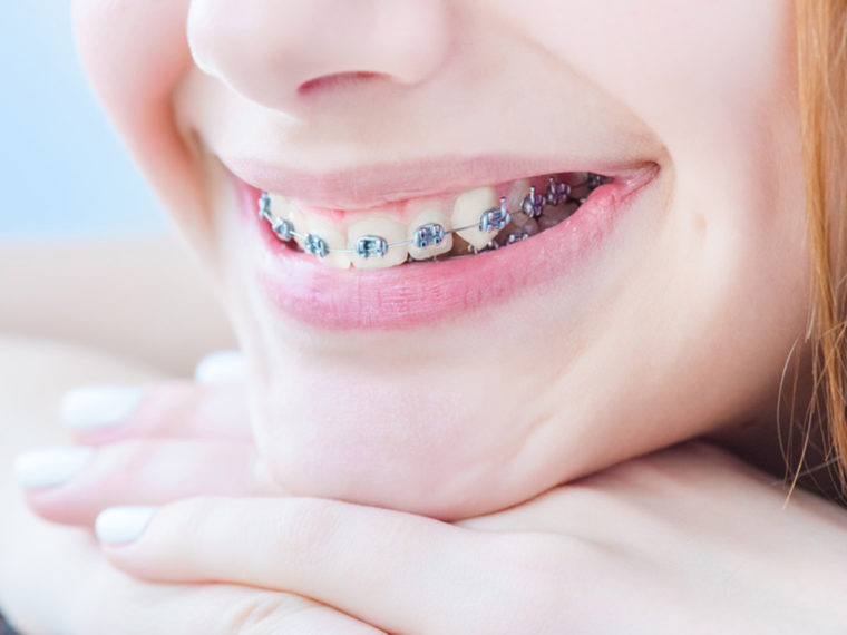 Tarifs de soins en orthodontie