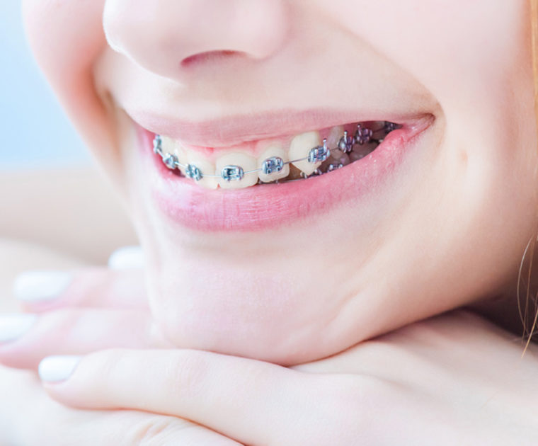 Tarifs de soins en orthodontie